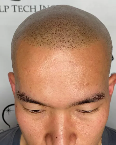 SMP before and after, front hairline