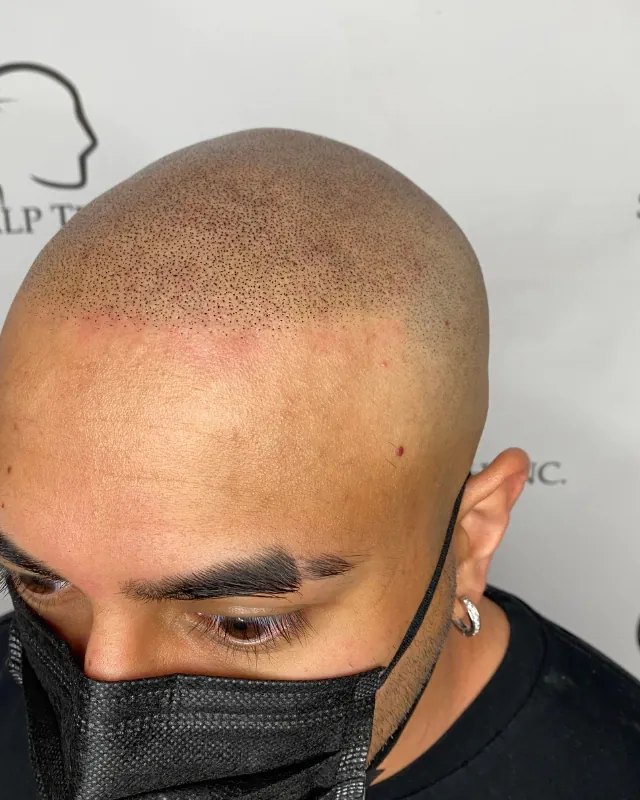SMP before and after, receding hairline
