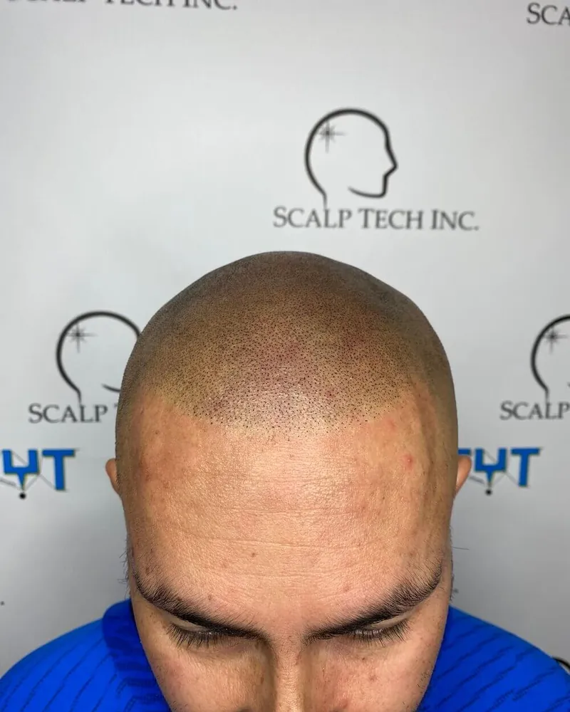 Healed scalp micropigmentation, front view
