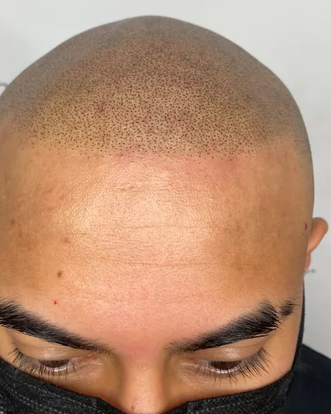 Healed scalp micropigmentation, top down