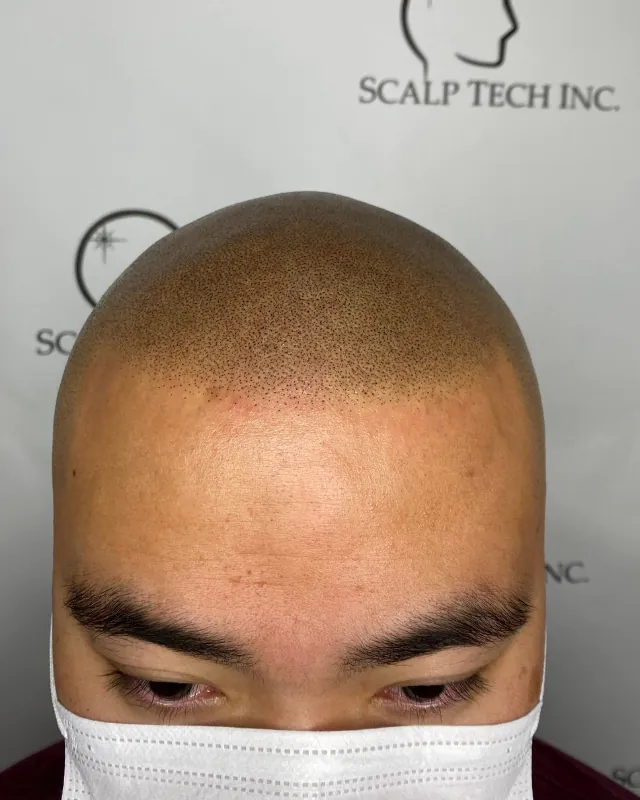 SMP before and after, crown