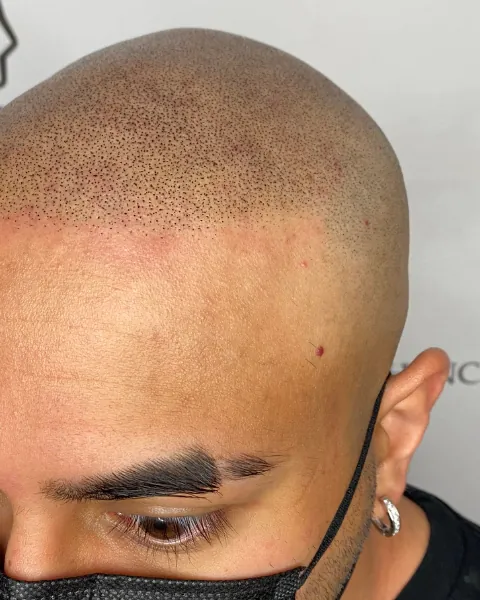 SMP before and after, side profile