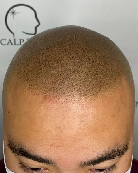 Healed scalp micropigmentation, darker skin tone