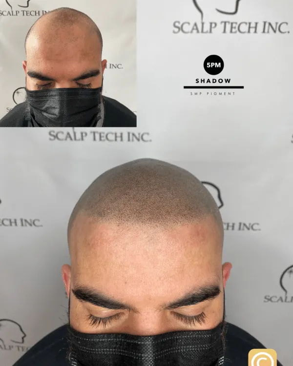 SMP before and after, full scalp