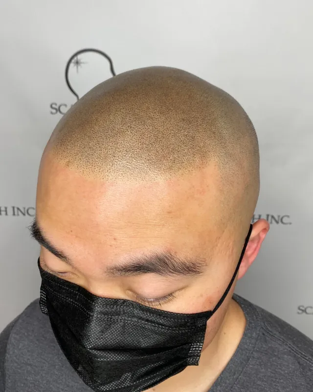 SMP before and after, hairline