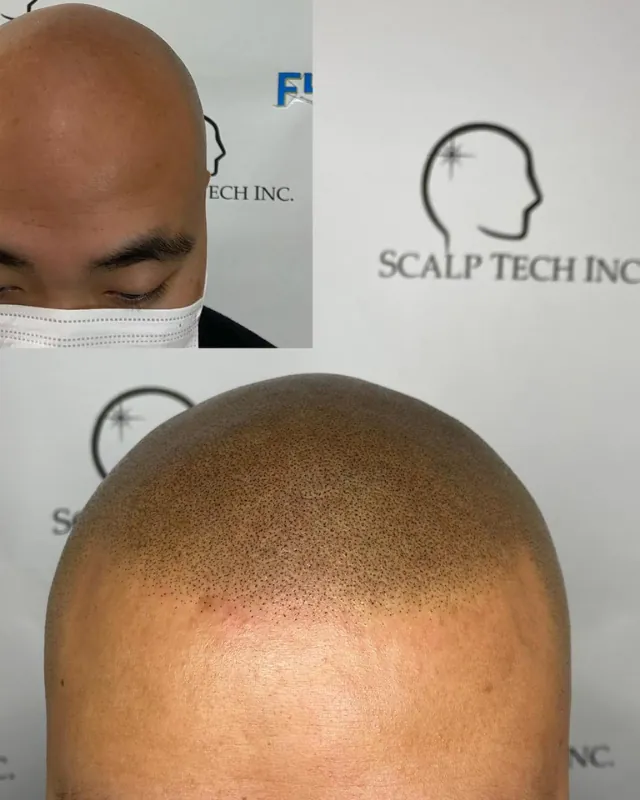Healed scalp micropigmentation, side
