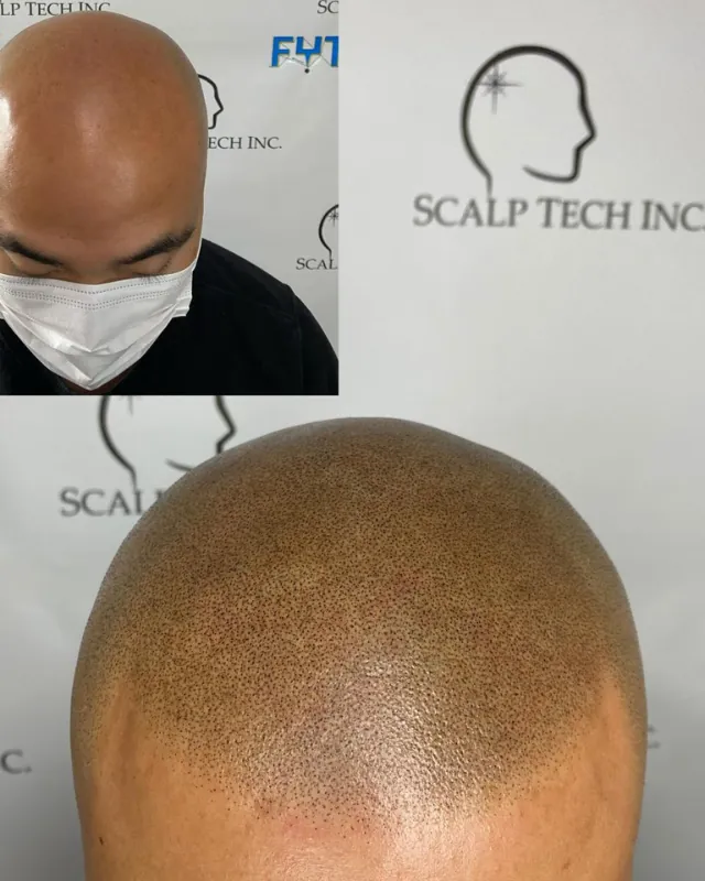 SMP before and after, front